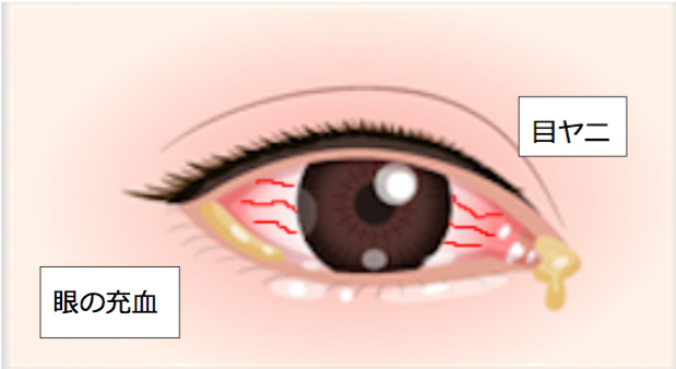 目 の 充血 原因 片目